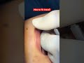 How to fix brace? #brace #fixbrace #orthodontics