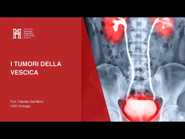 I Tumori della Vescica