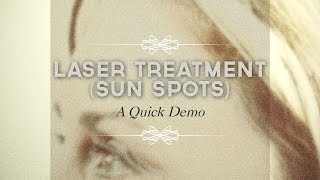 Laser treatment of sun spots