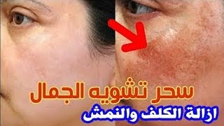 علاج الكلف في الوجه والبقع الداكنة على البشرة فى 3 أيام وصفة رهيبة جدا تزيل التصبغات مهما كانت قديمة