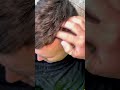 Bombastic scratches asmr scalpscratching relaxing sleeping dandruff flakes satisfying fyp