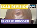 Surgical Correction of the "Reverse Unicorn"