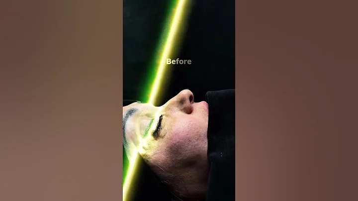 Before After #shorts #rhinoplasty #shortsvideo #ринопластика