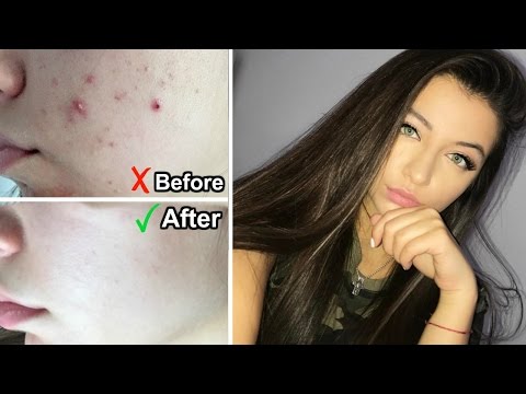 HOW I CLEARED MY ACNE IN 1 WEEK!!! +PROGRESS PICTURES
