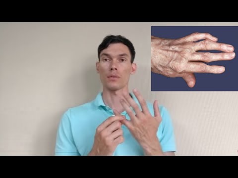 Видео: АРТРОЗ ПАЛЬЦЕВ РУК РАЗРАБОТКА arthrosis of the fingers