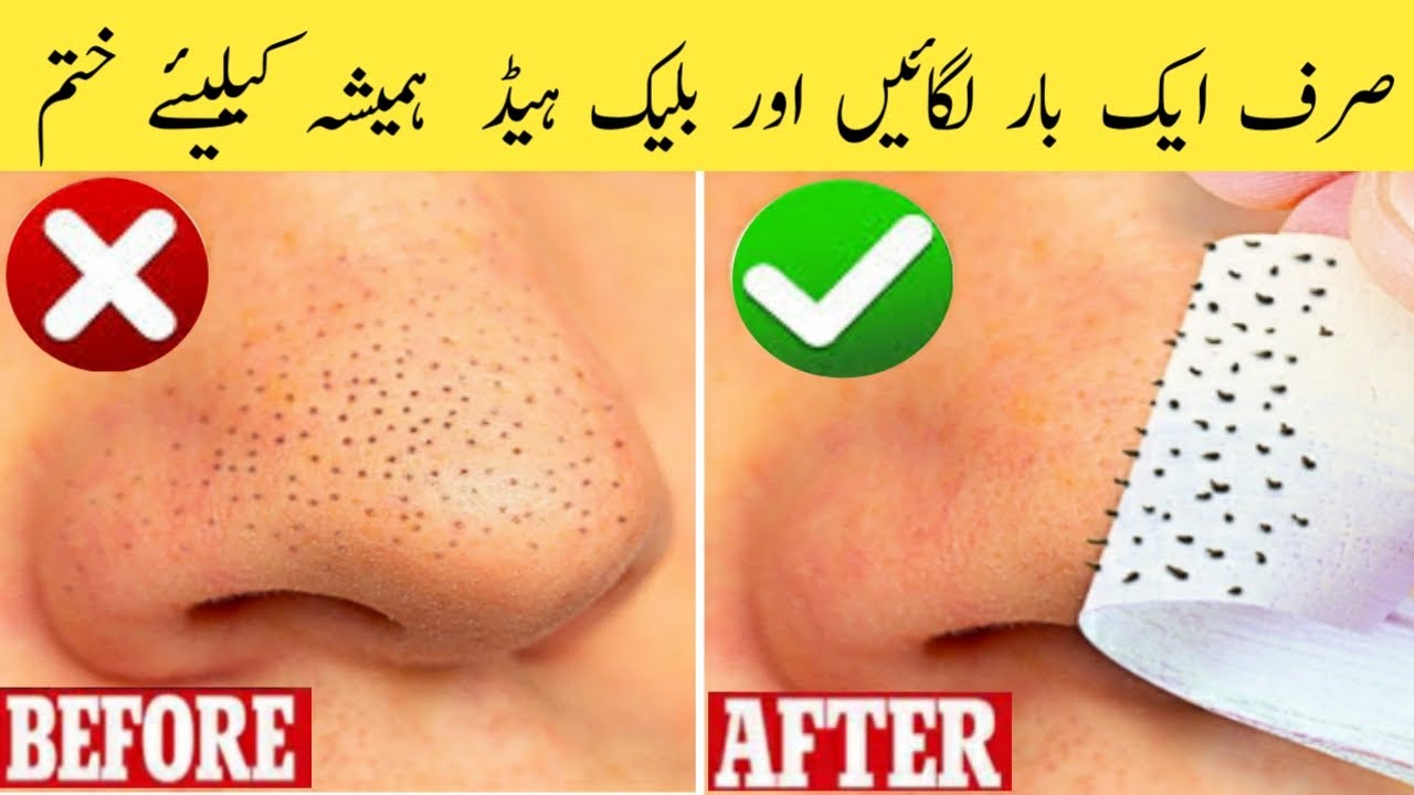 How to Remove Black Head at Home | Easy Way To Remove Black Heads ...