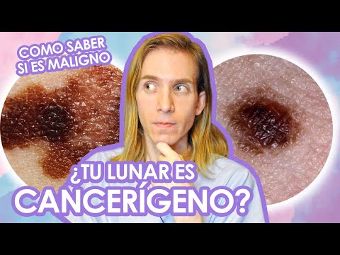 Video: ¿Los lunares asimétricos pueden ser benignos?