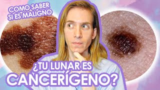 COMO CONTROLAR TUS LUNARES : ¿Es un LUNAR MALIGNO? Como saberlo - Recomendaciones de un dermatologo