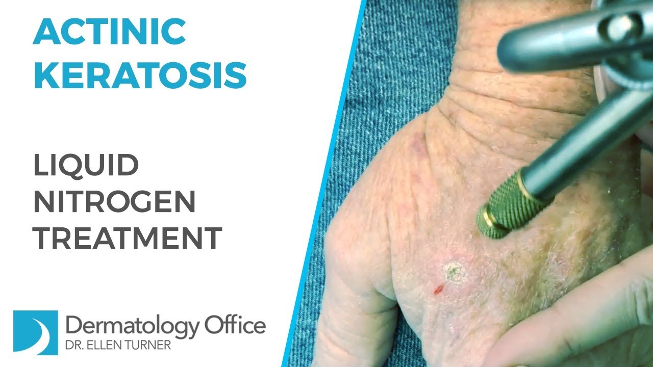 Liquid Nitrogen For Actinic Keratosis YouTube liquid-nitrogen-for-actinic-keratosis-youtube