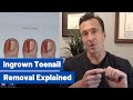 Ingrown Toenail Removal: Dr Moore Explains the Permanent, Cosmetic Procedure
