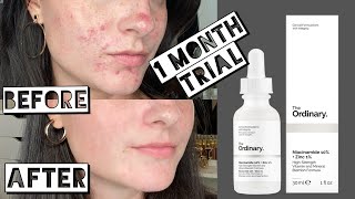 TESTING THE ORDINARY NIACINAMIDE AND ZINC FOR MY ACNE SCARRING FOR 1 MONTH screenshot 5