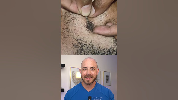 Doctor reacts to huge ingrown hair removal! #dermreacts #doctorreacts #ingrownhair