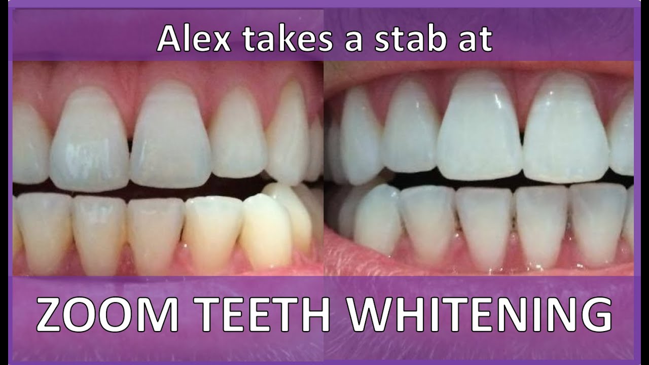 Zoom Teeth Whitening Review Alex Takes A Stab At Teeth with regard to Teeth Whitening Reviews