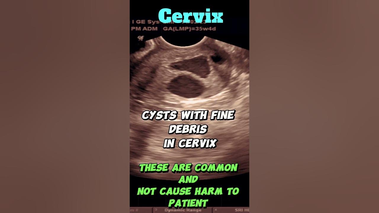 nabothian-cysts-in-cervix-tvs-ultrasound-is-this-serious-youtube