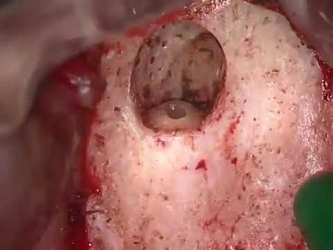 ACTEON EndoSuccess Apical Surgery Piezo
