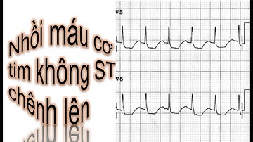 Đọc Điện tâm đồ(ECG): video 13: Nhồi máu cơ tim cấp không ST chênh lên 2
