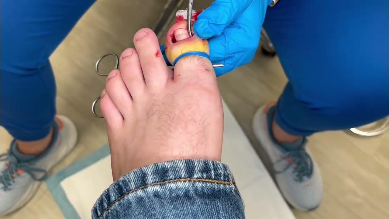Insane TOTAL ingrown toenail removal YouTube