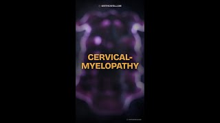 Cervical Myelopathy: Clumsy Hands & Gait Disturbance | OrthoVellum