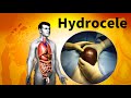 हाइड्रोसील कैसे होता हैं ? Hydrocele science