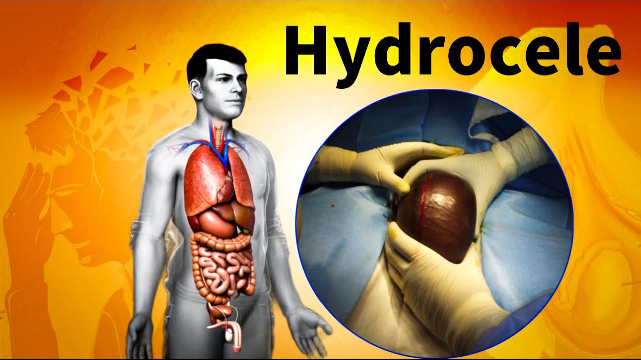 Hydrocele in 2 minutes YouTube