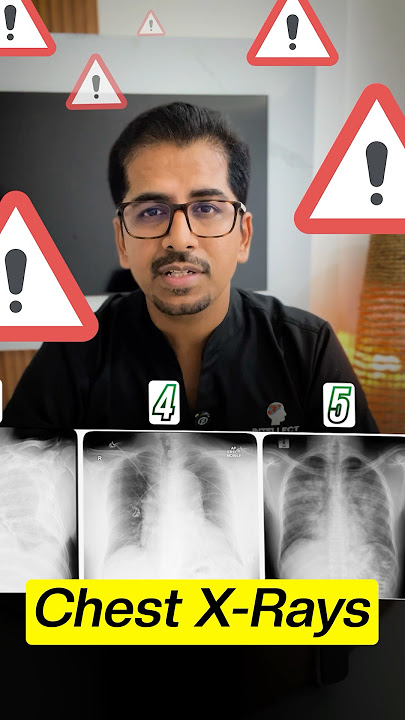 5 Chest X-rays that need Immediate Action (Must know) #xray #cxr #icu