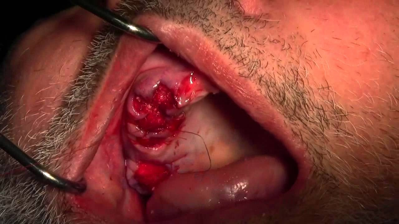Extractions #4-7 with Simple Socket Bone Grafting, Part I