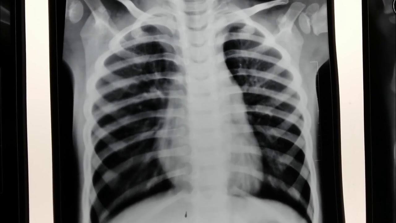 Hyperinflated chest x ray youtube