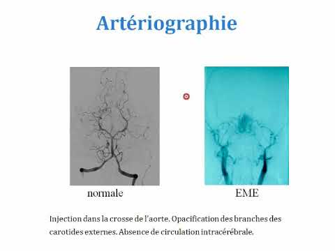 Vidéo: Récupération D'organes Transplantables Après Une Mort Cardiaque Ou Circulatoire: Transformer Le Paradigme De L'éthique Du Don D'organes