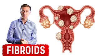 The Best Foods to Shrink Fibroids