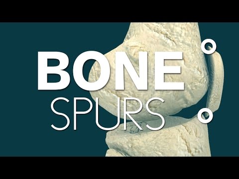 What causes bone spurs in knees?