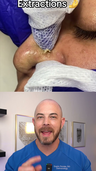 Derm reacts to super satisfying nose pimple pops! #dermreacts #dictorreacts #pimplepop