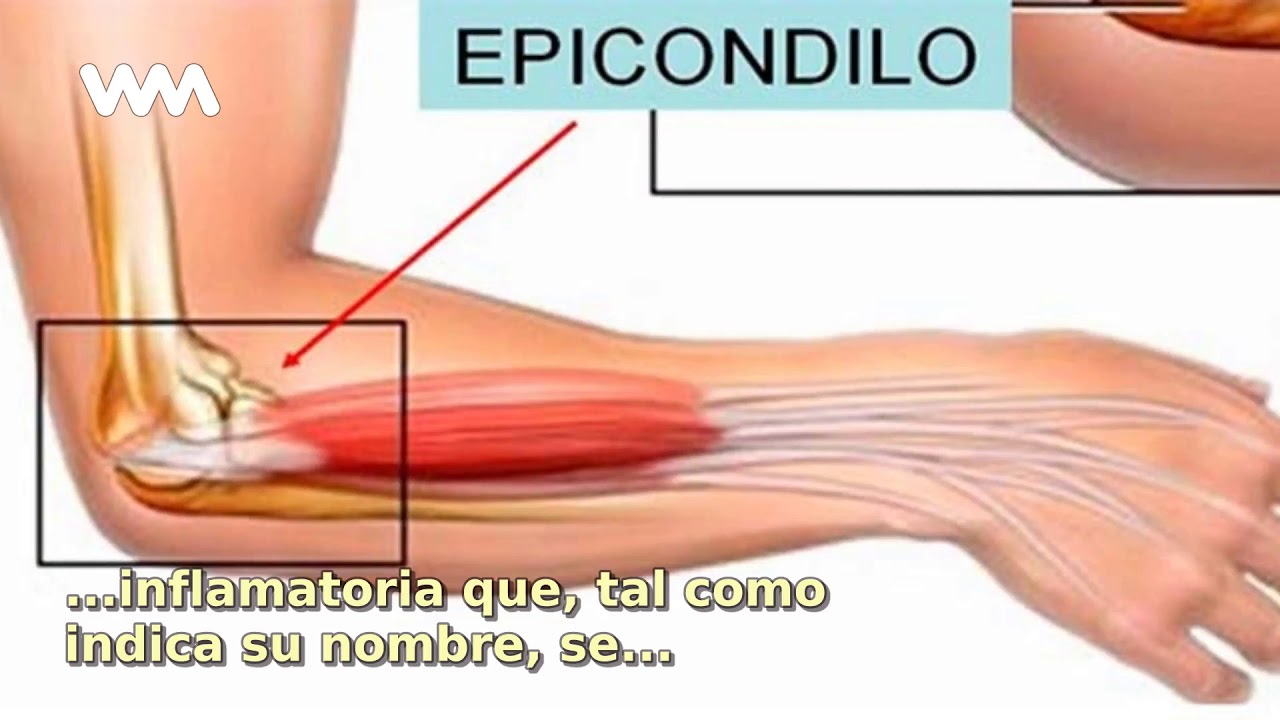 Que Es Epicondilitis Que Es Epicondilitis
