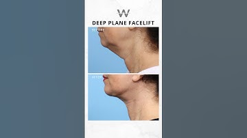 Before and after results: Deep Plane Facelift to tighten sagging jowls and loose neck skin