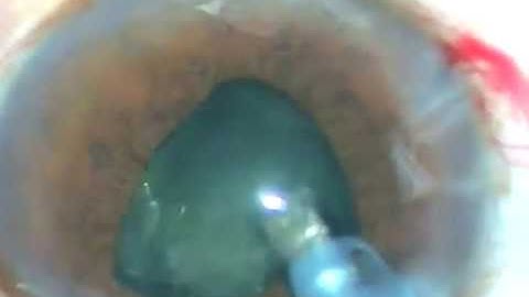 Cataract with Small Pupil - Safety measures for Phaco without pupil-dilating-devices