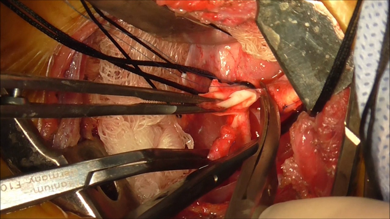 Coarctation Of Aorta Repair Youtube