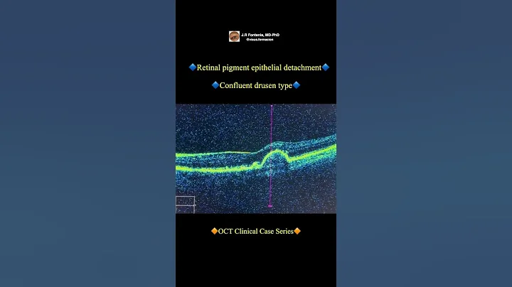 Confluent drusen type. Retinal pigment epithelial ...