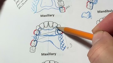 Cast Partial Denture Design Kennedy Class II