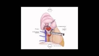 STS University Course 8: VATS Lobectomy
