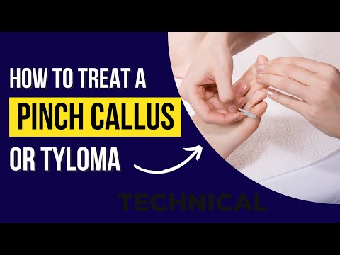 How to treat a pinch callus or Tyloma? How to stop a pinch callus from reforming?