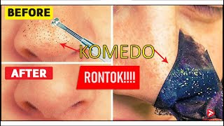 Cara menghilangkan jerawat di hidung dengan waktu semalam