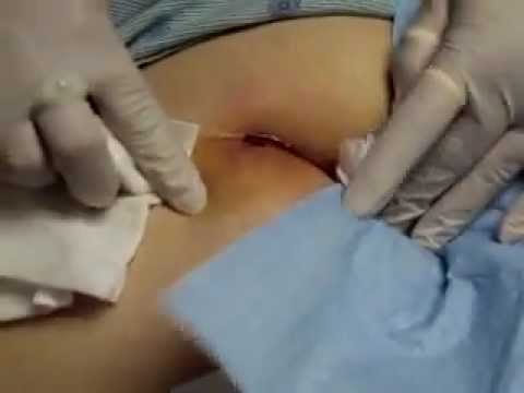 Cyst Ass 55