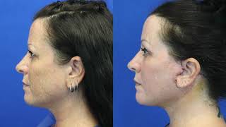 Facelifts, Neck Lifts In Strong Demand Says Beverly Hills Plastic Surgeon