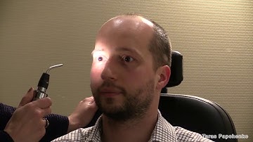 Assessment of Relative Afferent Pupillary Defect (RAPD)