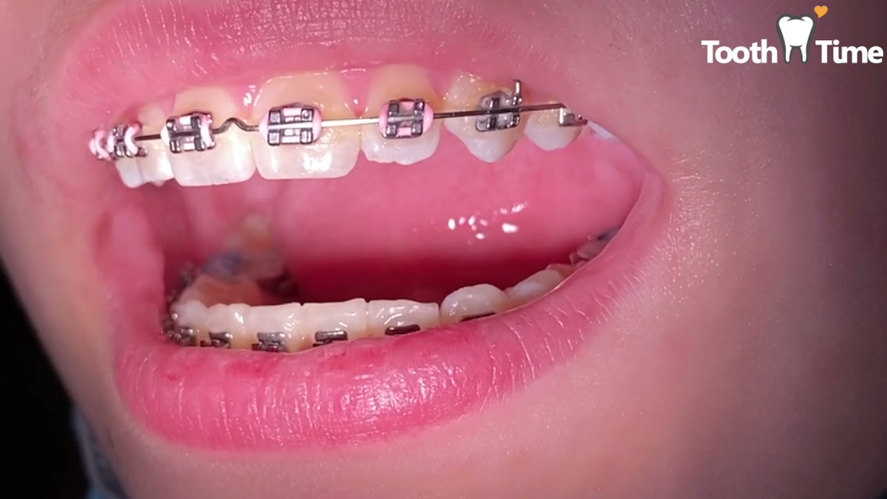 Braces wires - from wire 016 to a niti 18x25 - Tooth Time Family Dentistry  New Braunfels 