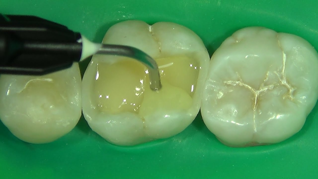 Classe II – Resina Injetável (Class II – Injectable Composite)