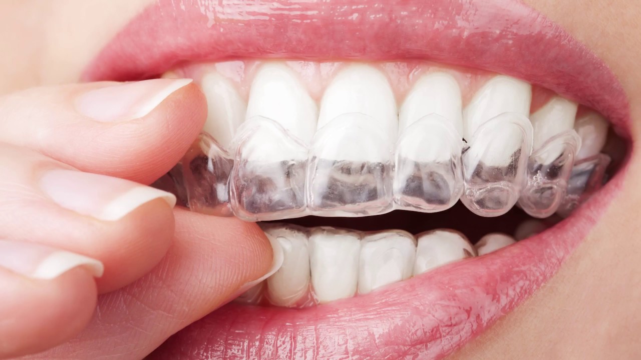 Will Teeth Whitening Damage My Tooth Enamel Dentist In for Incredible  teeth whitening damage regarding Current Residence