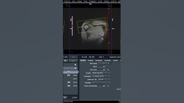 MRI Shoulder Joint #mri #doctor #diagnosis #treatment #paramedical #alliedhealth  #surgery #surgeon