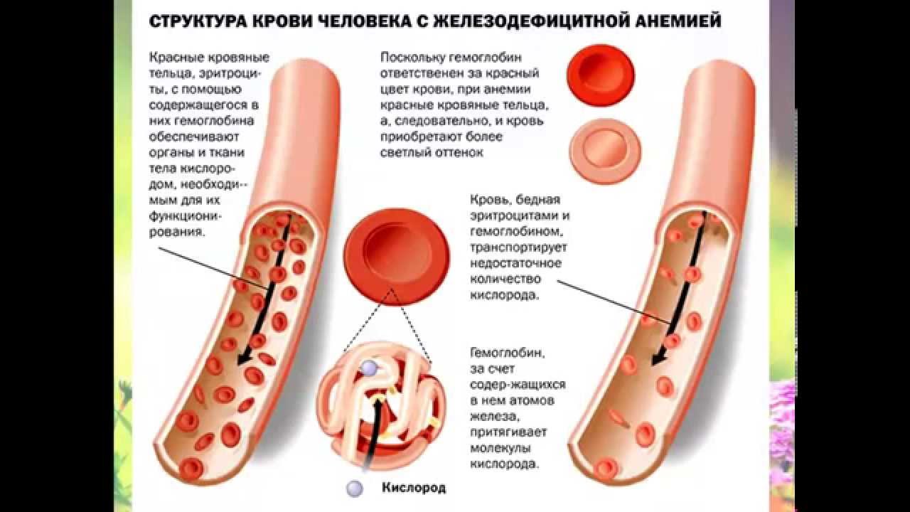 Системная анемия