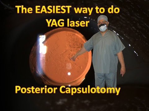 What is the EASIEST way to do YAG laser  posterior Capsulotomy