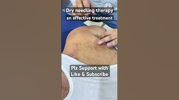 Dry needling therapy #dryneedling #needling #shorts #shortsfeed #viral